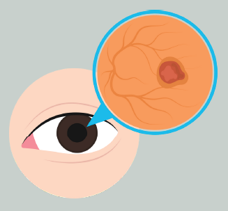 DETEKSI DINI GLAUKOMA DAN RETINOPATI