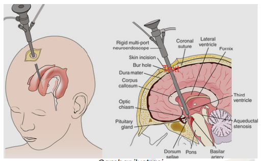 TERAPI HIDROSEFALUS DENGAN ETV