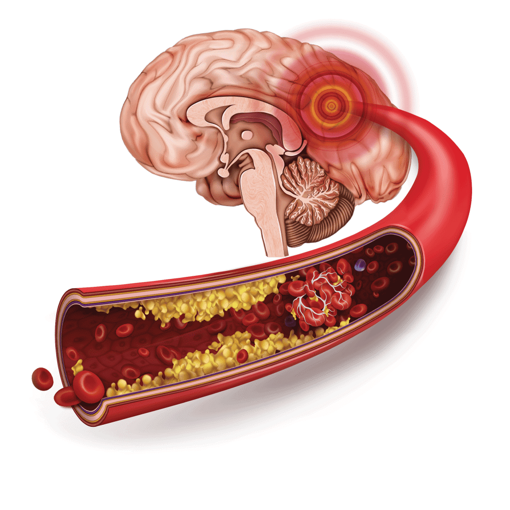 KETIKA DETIK MENJADI NYAWA : PENCEGAHAN DAN PENANGANAN STROKE ISKEMIK DI RSUD BANTEN